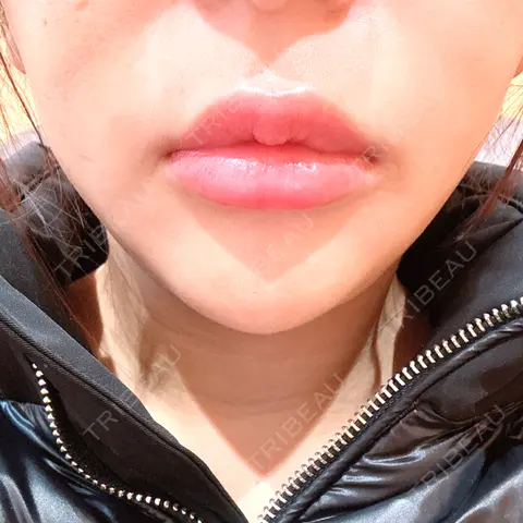 人中短縮 / 口角挙上 R Beauty CLINIC 銀座院 AFTER