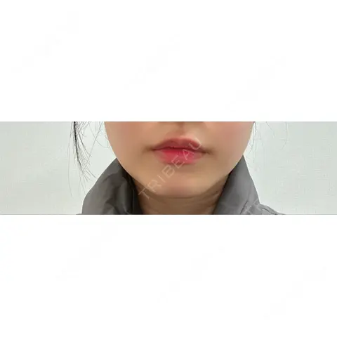 糸リフト 形成外科と美容外科のクリニック池袋 AFTER