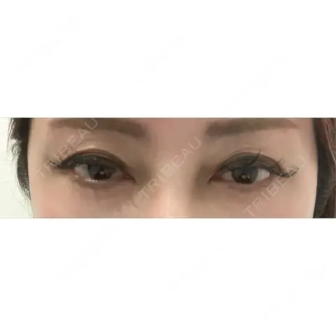 二重切開 / 眼瞼下垂（切開） / 上まぶたたるみ取り 東京シンデレラ美容外科 大宮院 AFTER