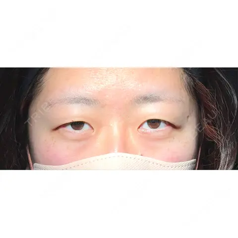 二重埋没 アリエル美容クリニック 大宮院 AFTER