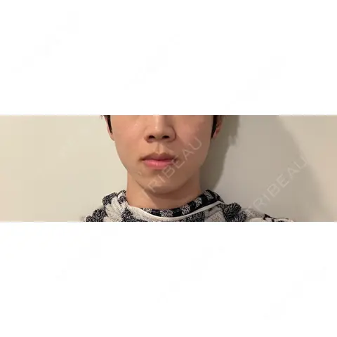 ボトックス（首） KAGA CLINIC AFTER