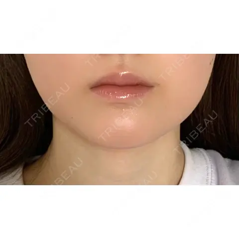 ボトックス（エラ・小顔） / ヒアルロン酸注入（唇） / ボトックス（口角） / ボトックス（人中） L‘amour clinic Tokyo【ラムールクリニック東京】 AFTER
