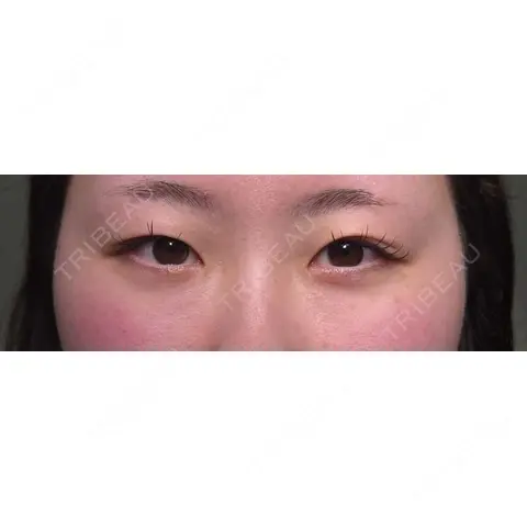 二重埋没 HAAB×DREAM BEAUTY CLINIC 大阪梅田院 AFTER