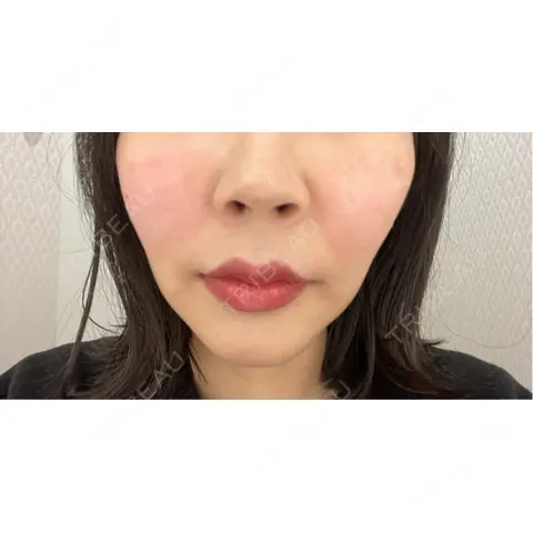 脂肪溶解注射（顔） AZ BEAUTY CLINIC AFTER