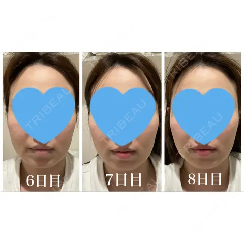脂肪溶解注射（顔） 日比谷セントラルクリニック AFTER