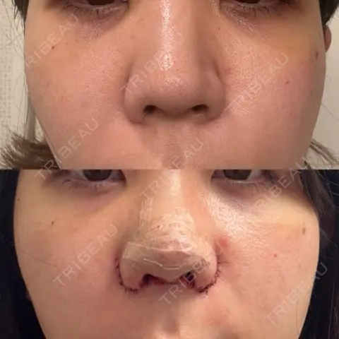 鼻尖形成（切開） / 鼻中隔延長（切開） / 小鼻縮小（切開） / 軟骨移植 RIVER CLINIC（リバークリニック） AFTER