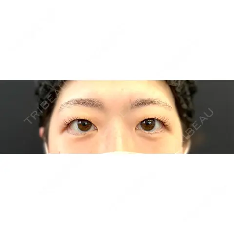 二重埋没 湘南美容クリニック 千葉センシティ院 AFTER