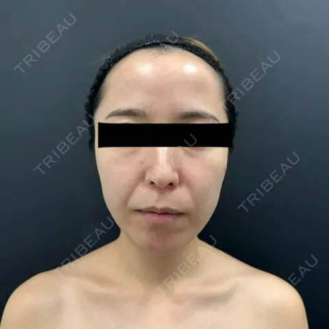 糸リフト / 脂肪吸引（顔） BLINC CLINIC （ブリンク クリニック） AFTER