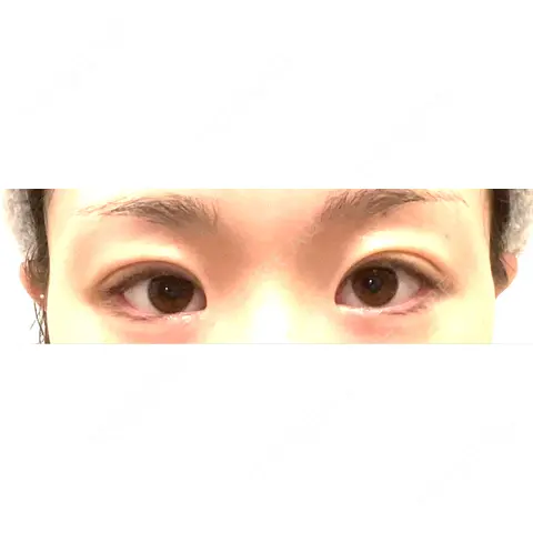 二重埋没 / 自然癒着法 Ginza 78 Clinic AFTER