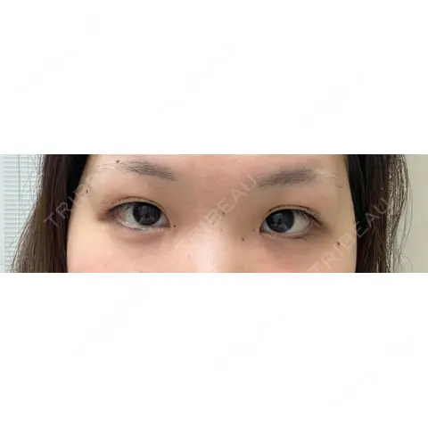 二重埋没 / 目頭切開 / 上まぶたの脂肪取り / 自然癒着法 MEMOTO CLINIC 名古屋 AFTER