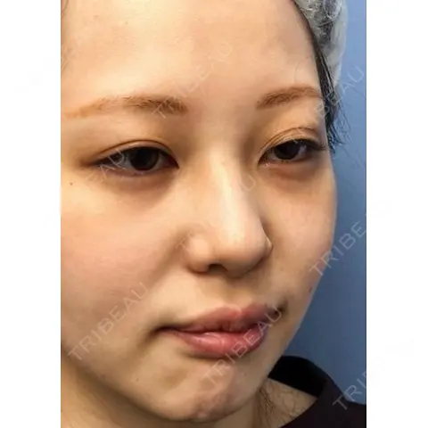 二重埋没 / 目頭切開 / 鼻尖形成（切開） / 鼻中隔延長（切開） / 軟骨移植 / ヒアルロン酸注入（鼻） / ヒアルロン酸注入（あご） 湘南美容クリニック 新潟院 AFTER