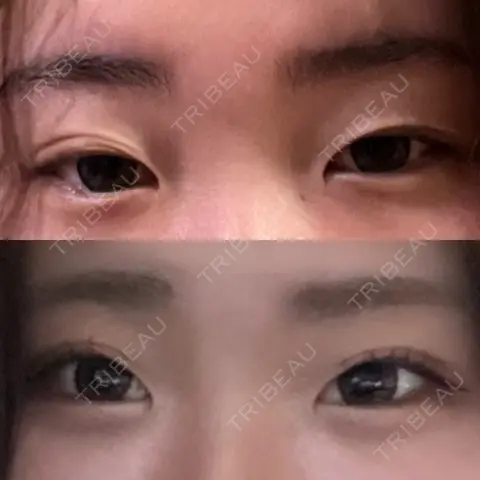 二重埋没 / 自然癒着法 Brandnew Beauty Clinic AFTER