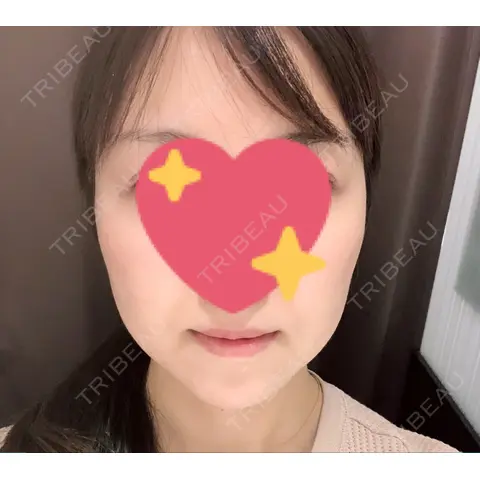 糸リフト / ボトックス（あご） / ヒアルロン酸注入（あご） 湘南美容クリニック 札幌院 AFTER