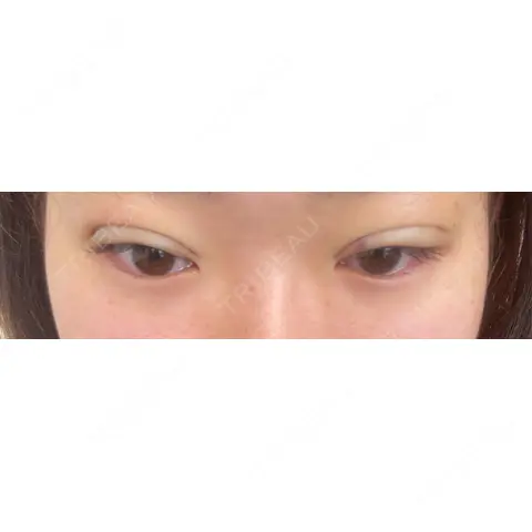 二重埋没 / 上まぶたの脂肪取り THE FIRST CLINIC 多摩センター院 AFTER