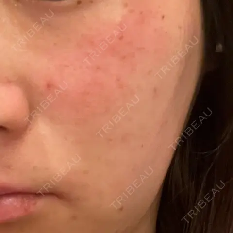 ピーリング（ハリ・ツヤ） / ルメッカ GLAMRULE CLINIC (グラムルール クリニック) 銀座院 AFTER