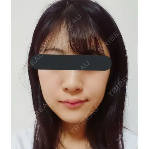 隆鼻術 / 小鼻縮小（切開） 湘南美容クリニック 熊本院 AFTER