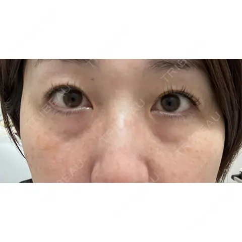 クマ治療 / 下まぶたの脂肪取り ROOTS Clinic AFTER