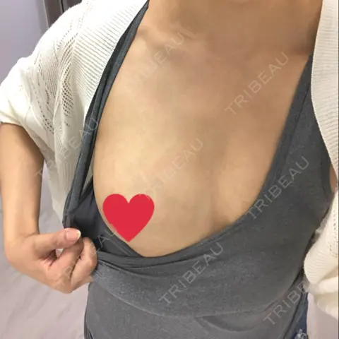 豊胸（ヒアルロン酸） TCB東京中央美容外科 池袋西口院 AFTER