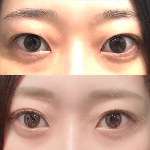 二重埋没 湘南美容クリニック 池袋東口院 AFTER