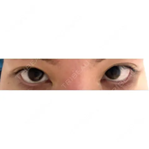 目尻切開 / タレ目形成・グラマラスライン（切開） / 目尻靭帯移動 エターナル美容クリニック AFTER
