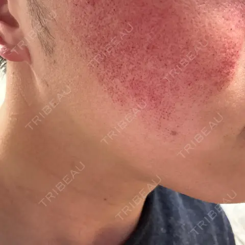 ピコレーザートーニング（美白・肝斑） / ピコフラクショナルレーザー（毛穴・ニキビ跡） APスキンクリニック銀座 AFTER