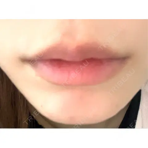 ボトックス（あご） / ヒアルロン酸注入（唇） / マイクロボトックス / ボトックス（額） KAGA CLINIC AFTER