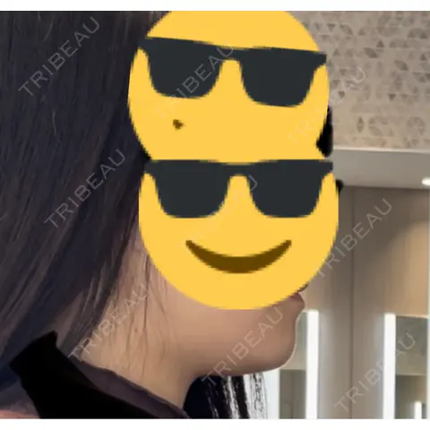 脂肪溶解注射（顔） 日比谷セントラルクリニック AFTER