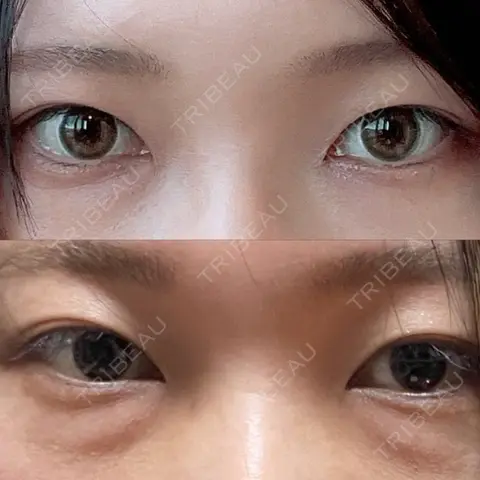 二重埋没 / クマ治療 / 上まぶたの脂肪取り / 下まぶたの脂肪取り / 自然癒着法 / ヒアルロン酸注入（目の下） / スネコス MEMOTO CLINIC 名古屋 AFTER