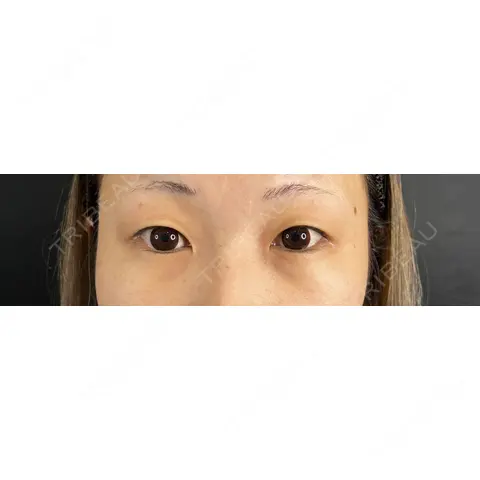 二重埋没 / クマ治療 / 上まぶたの脂肪取り / 脂肪注入（目の下） 藤・ナチュレ美容クリニック 銀座院 AFTER