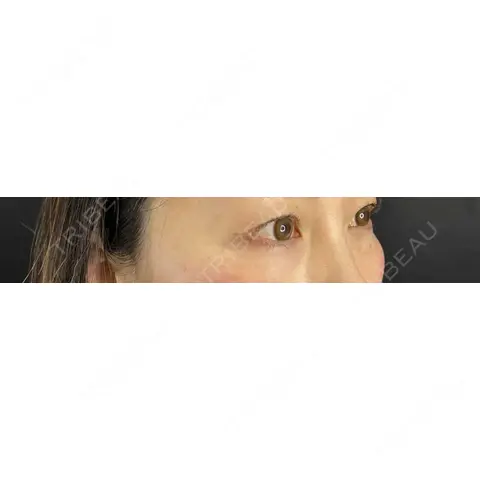 クマ治療 / 脂肪注入（目の下） 藤・ナチュレ美容クリニック 銀座院 AFTER