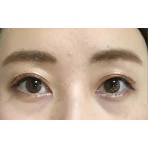 二重埋没 湘南美容クリニック 熊本院 AFTER