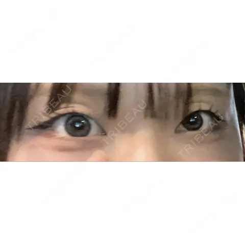 二重埋没 恵聖会クリニック 心斎橋院 AFTER