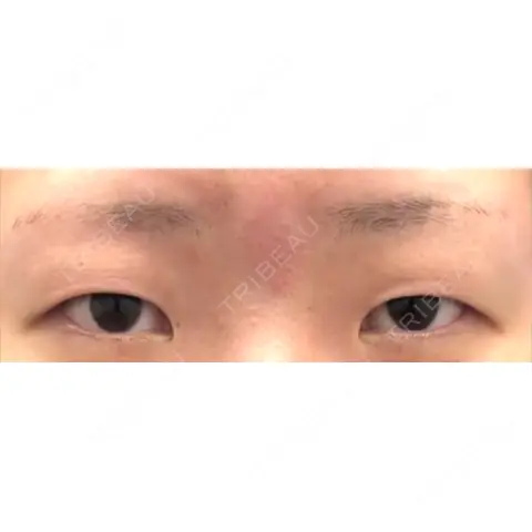 二重切開 / 目頭切開 / 目尻切開 湘南メディカル記念病院（両国） AFTER