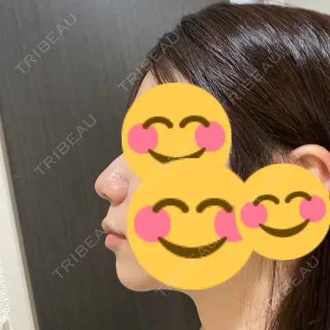 軟骨移植 / ワシ鼻修正・ハンプ切除 / 鼻尖形成（非切開） / 鼻柱下降・鼻唇角形成（猫手術） 東京美専クリニック AFTER