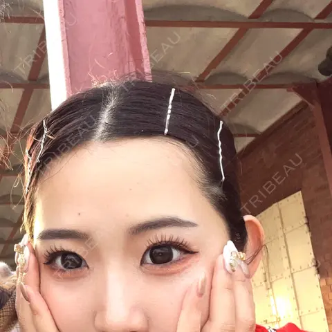 二重埋没 / 目頭切開 / 自然癒着法 東京シンデレラ美容外科 大宮院 AFTER
