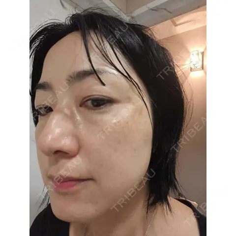 レーザートーニング（美白・肝斑） 銀座TSUBAKIクリニック AFTER