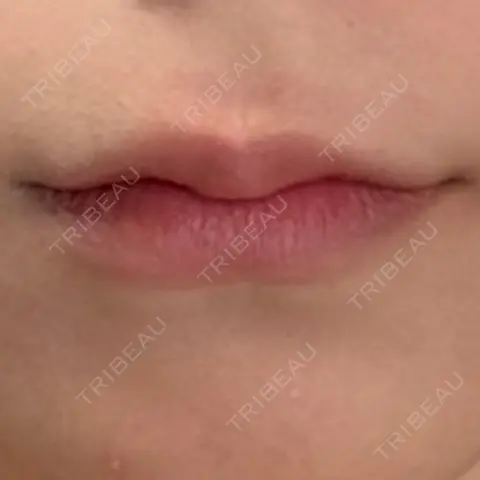 ヒアルロン酸注入（唇） AZ BEAUTY CLINIC AFTER