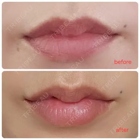 ヒアルロン酸注入（唇） AZ BEAUTY CLINIC AFTER