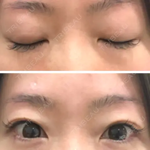 二重埋没 大阪TAクリニック AFTER