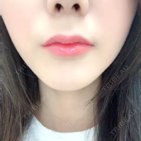 ヒアルロン酸注入（唇） / ボトックス（口角） フィラークリニック 恵比寿院 AFTER