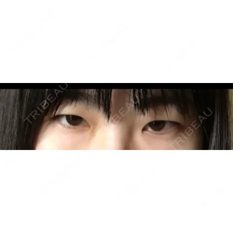 二重切開 / 目頭切開 / 眼瞼下垂（切開） / 目尻切開 ジュエリー美容外科 AFTER