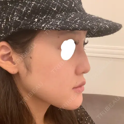 ヒアルロン酸注入（鼻） BIANCA銀座 AFTER