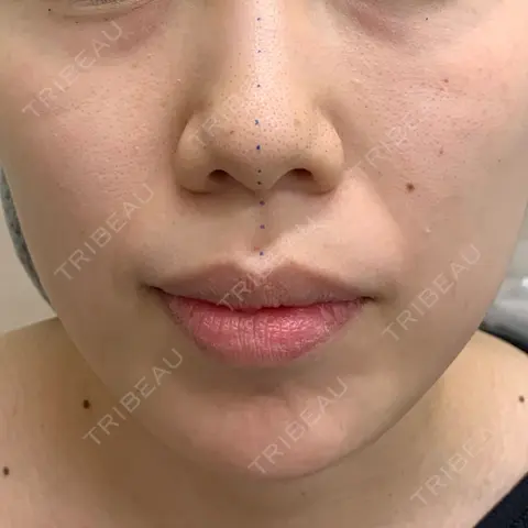 鼻中隔延長（切開） 湘南美容クリニック 新潟院 AFTER