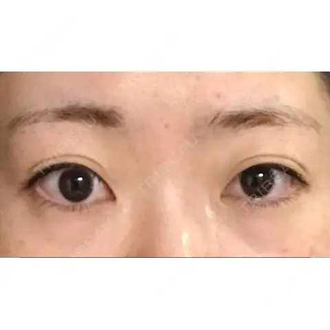 目頭切開 / 目尻切開 / 下まぶたの脂肪取り / 脂肪注入（肌） / ヒアルロン酸注入（涙袋） プロミス整形外科 AFTER