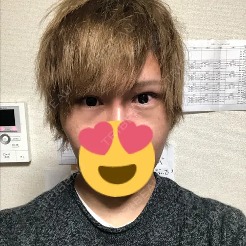 ヒアルロン酸注入（涙袋） abijouクリニック AFTER