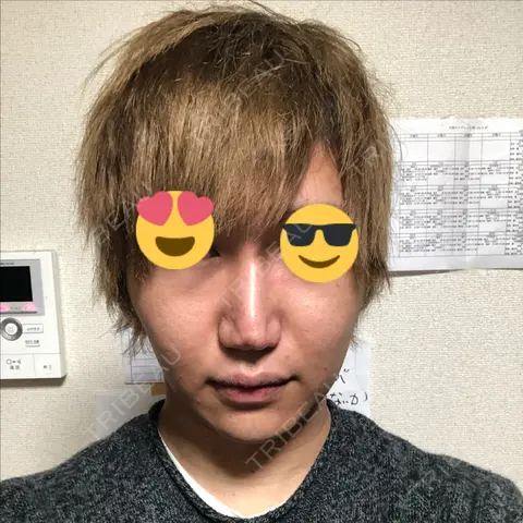 脂肪溶解注射（顔） abijouクリニック AFTER