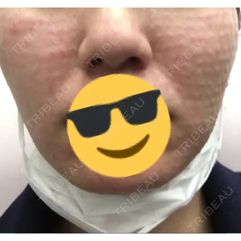 水光注射（ハリ・美肌） 銀座国際美容外科 池袋院 AFTER