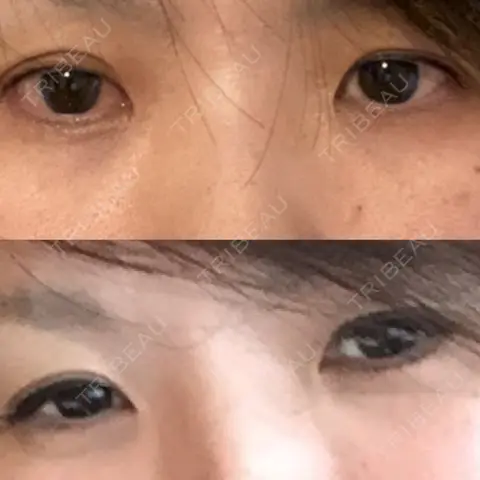 二重切開 / 目頭切開 / 目尻切開 / 眉間プロテーゼ id（アイディ）美容外科 AFTER