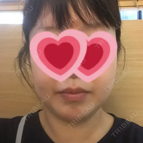 糸リフト / その他（輪郭） YJホーリック美容外科 AFTER
