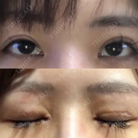 二重切開 / 目頭切開 / 眼瞼下垂（切開） こいずみ形成クリニック名古屋 AFTER